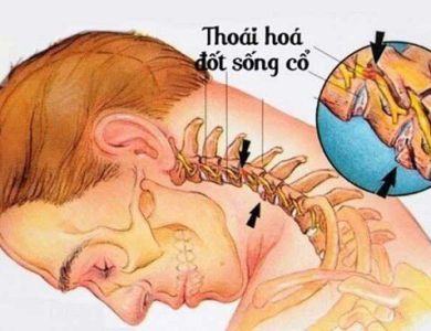 THOÁI HÓA ĐỐT SỐNG CỔ: HIỂU VỀ VẤN ĐỀ VÀ CÁCH PHÒNG TRÁNH