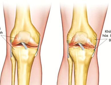 NHỮNG ĐIỀU CẦN BIẾT VỀ BỆNH THOÁI HÓA KHỚP GỐI.